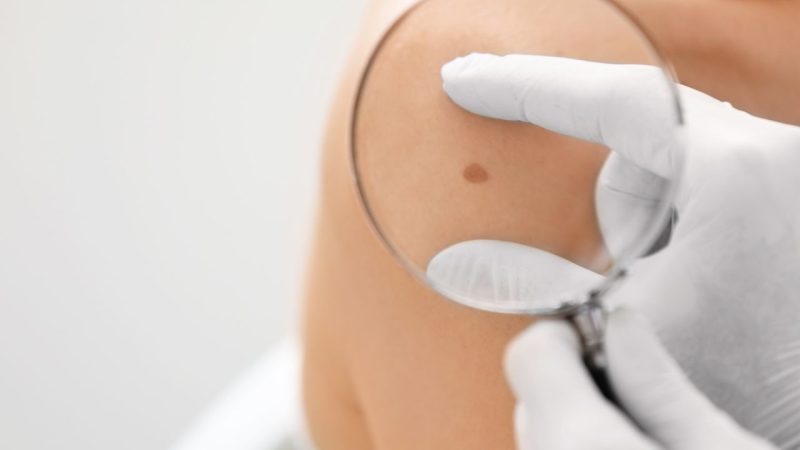 Signes méconnus cancer peau