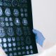 Alzheimer médicaments augmentent risque